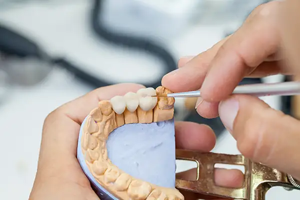 A dental technician completing precise finishing touches on a dental bridge. A dental technician completing precise finishing touches on a dental bridge.
