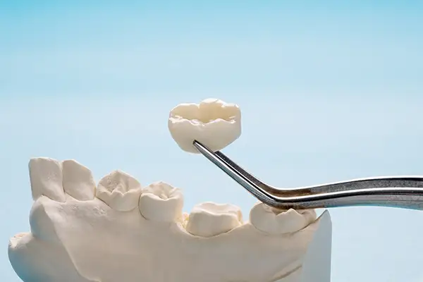 Ceramic dental crown held by tweezers above a dental model, showcasing precise restoration placement. Ceramic dental crown held by tweezers above a dental model, showcasing precise restoration placement.