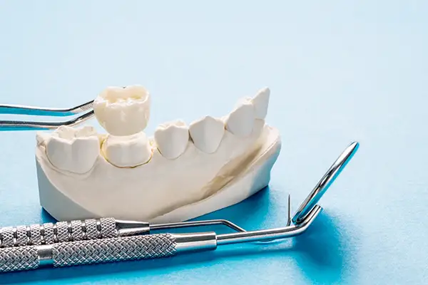 Close-up of a dental crown placed on a dental model, showcasing accurate fit and realistic tooth anatomy. Close-up of a dental crown placed on a dental model, showcasing accurate fit and realistic tooth anatomy.