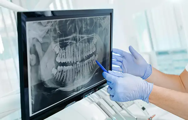 Close-up of a dental X-ray displayed on a computer monitor, with a dentist pointing to the image for analysis. Close-up of a dental X-ray displayed on a computer monitor, with a dentist pointing to the image for analysis.
