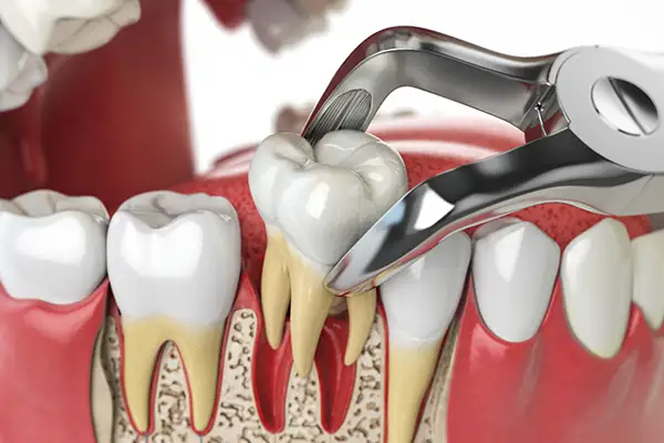 Cross-section view showing a dental tool extracting a molar from the gum, highlighting the tooth roots and surrounding bone.